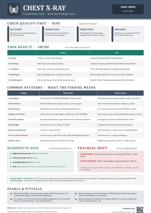 Chest X-Ray one-page infographic. A systematic read · what the findings mean.