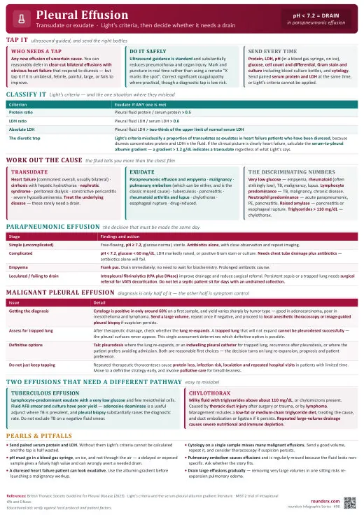 Pleural Effusion one-page infographic. Light criteria, then decide whether it needs a drain. Tap to open the full-size printable PDF.